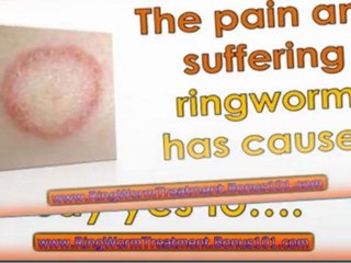 how to treat ringworm in humans - treating ringworm - ringworm treatment