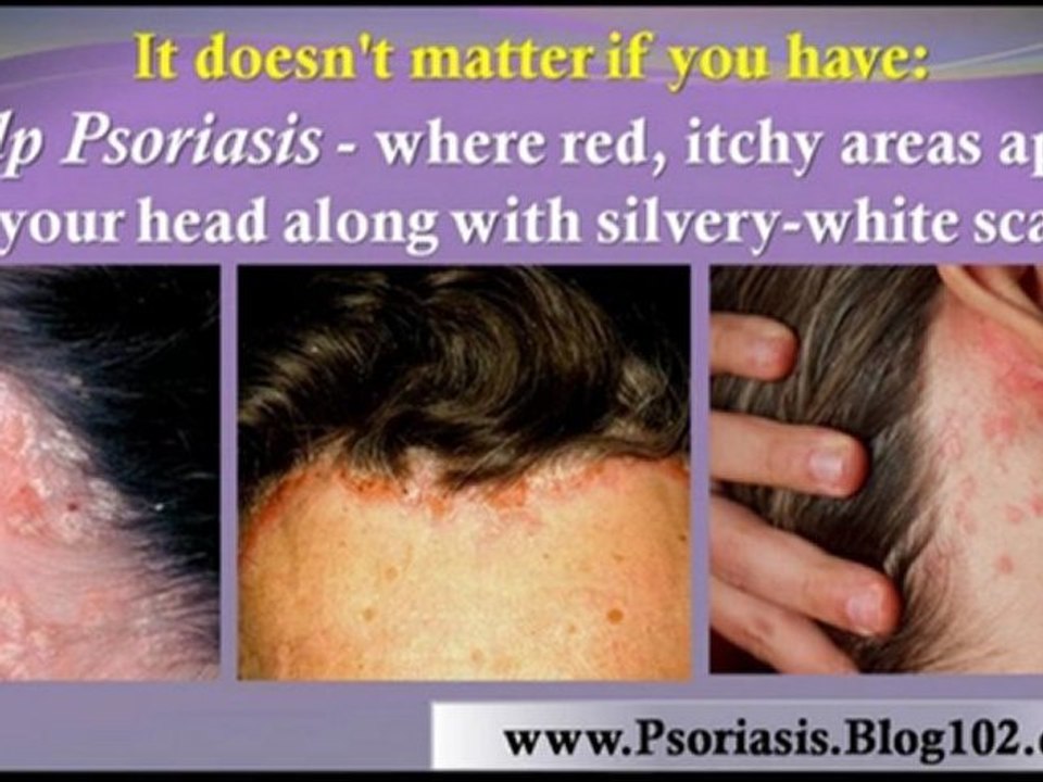 natural psoriasis treatment - psoriasis home remedies - psoriasis remedies