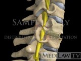 Cervical Anterior Discectomy Interbody Vertebral Fusion cage goals neuro-surgeon animations