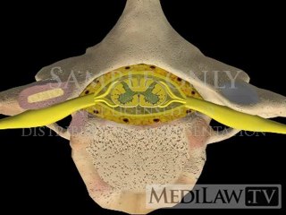 Cervical Spine Foraminotomy with burring Goals malpractice movies