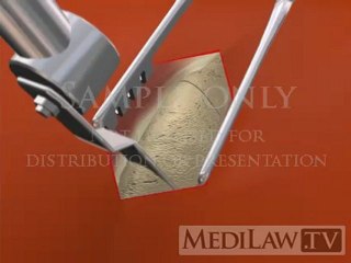 Bone Graft Harvesting Surgery anterior iliac crest neurosurgery animations