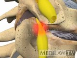 Cervical Spine Pathology Inter-vertebral Spinal Foraminal Stenosis rheumatologist animations
