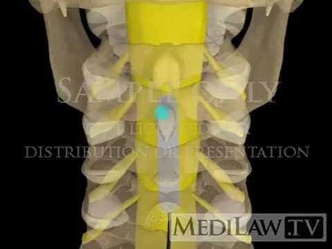 Cervical Spinal Cord Neuro-stimulation paddle pain management graphics