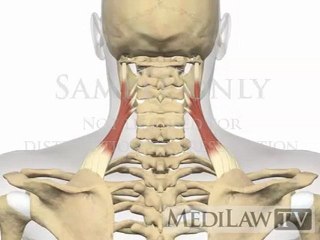 Cervical Spine Shoulder Elevation Muscles Levator Scapulae chiropractic presentations