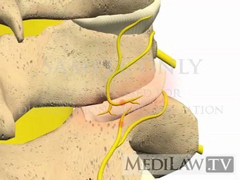 Cervical Spine Pathology Facet Zygoapophysial Joint Syndrome chiropractic multimedia