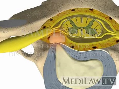 Cervical Spine Pathology Intervertebral Disc Sequestration medical evidence videos