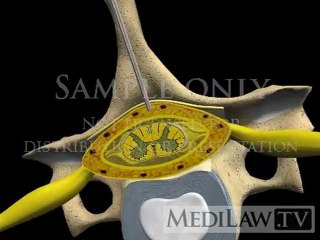 Cervical Spine Epidural Steroid Injection Block interlaminar sitting medical negligence movies