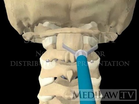 Cervical Spine Surgical Vertebral Atlanto-axial Trans-articular Screw Fusion Fixation medical trial exhibits movies