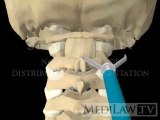 Cervical Spine Surgery Atlanto-axial Trans-articular Screw Fusion Fixation medico-legal exhibit videos