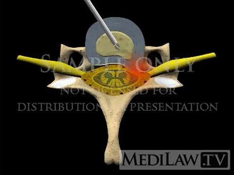 Cervical Spine Pain Management Decompression Intervertebral Percutaneous Manual Discectomy operation videos