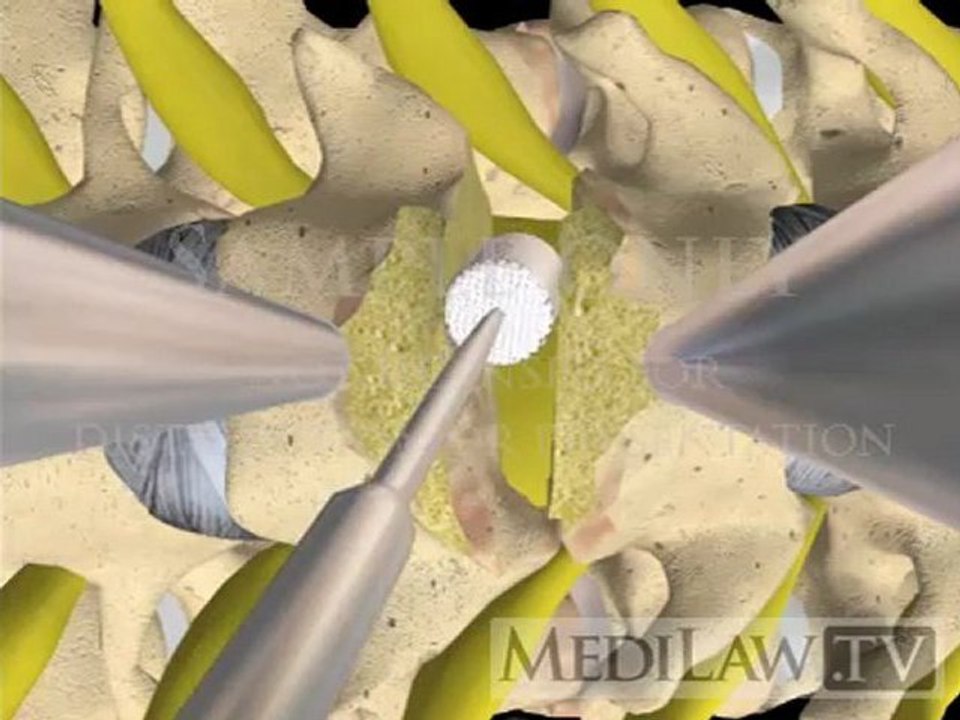 Cervical Spine Surgery Interbody Vertebral Fusion with cage fixation orthopaedic surgery movies