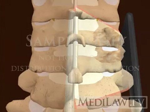 Cervical Spine Facet Joint Zygo-apophyseal Surgical Foraminotomy surgical decompression 3D animations