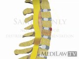 Spine Neck Pain Fracture Herniation Tear Rupture Bruise trial exhibit animations