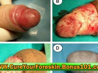 dry cracked foreskin treatment - phimosis in children treatm