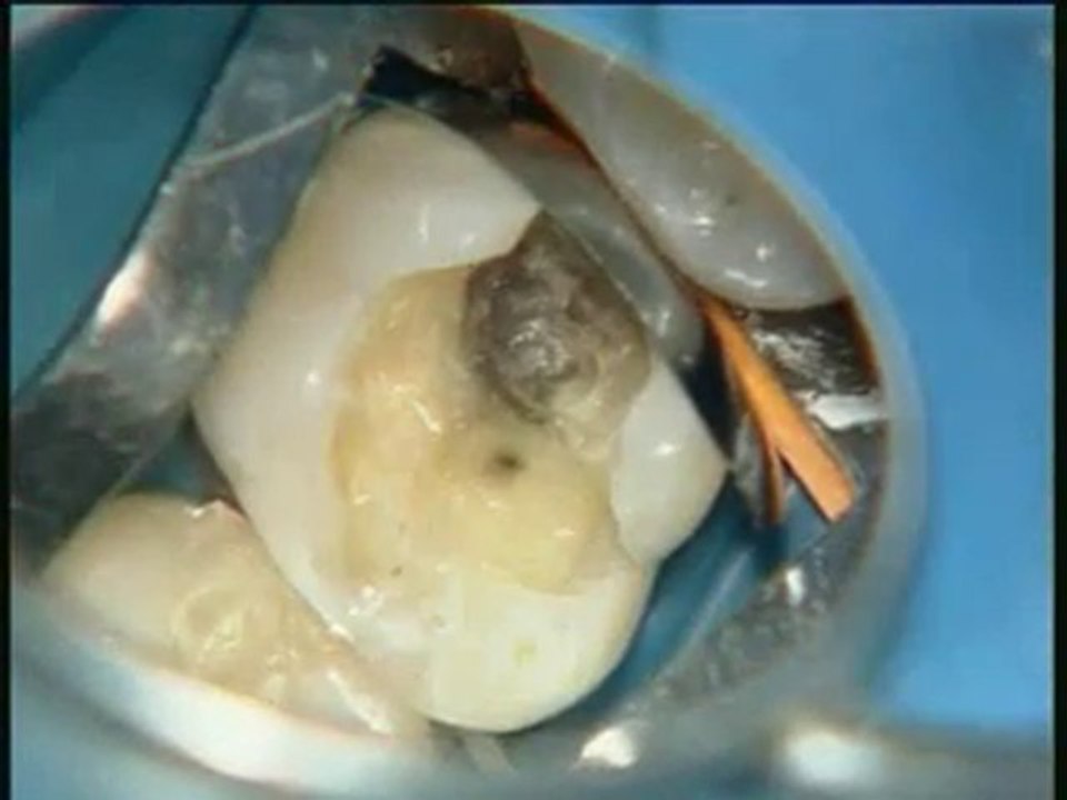 Composite : cas clinique du Dr. Pascal Zyman : cas 3
