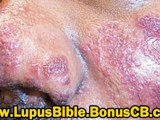 lupus bible - lupus books - thelupusbible - lupus cured - lu