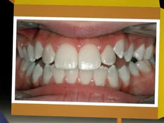 Orthodontist Braces Westminster