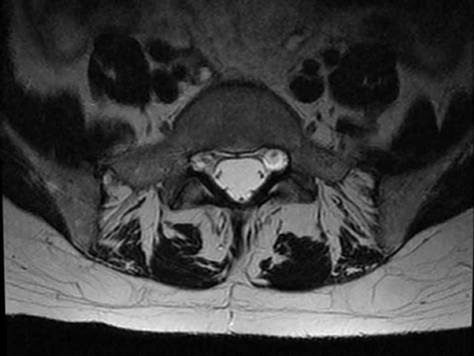 Arachnoidite - arachnoiditis