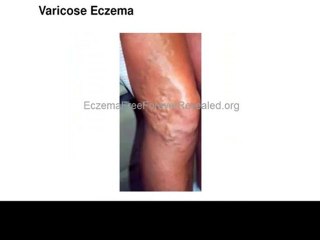 Eczema Free Forever - Honest Review