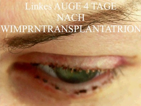 Wimperntransplantation In Berlin Meine Neuen Wimpern Video Dailymotion