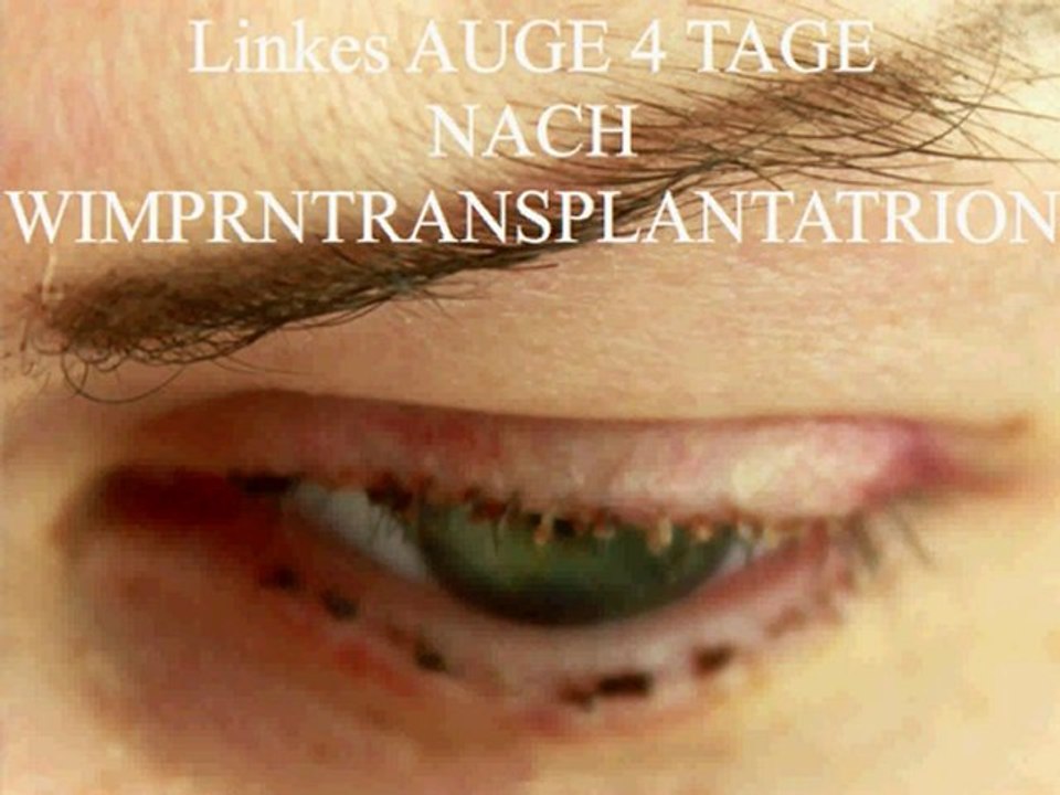 wimperntransplantation in Berlin Meine neuen Wimpern