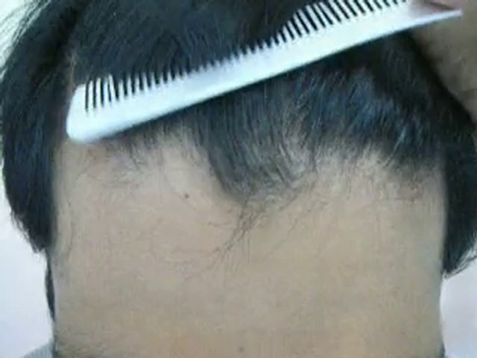 Scarless Surgery -FUE Pakistan-Hair transplant result