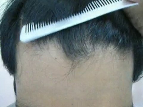 Scarless Surgery -FUE Pakistan-Hair transplant result