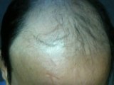 Baldness-Hair Loss-Hair restoration Clinic Pakistan Part 1