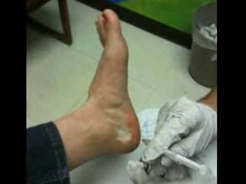 Heel Pain - Plantar Fasciitis - Podiatrist in San Mateo and