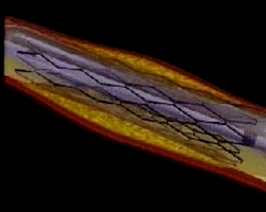 Stent for heart