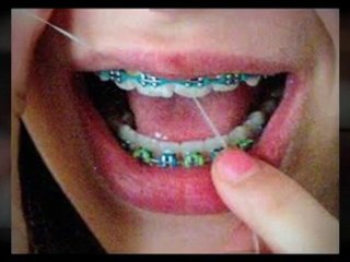 Teeth Braces Guide