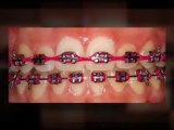 Teeth Braces Tips