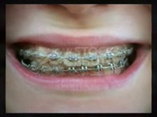 Braces On Teeth