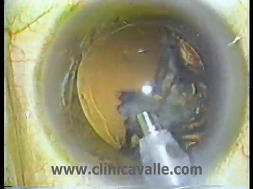 Facoemulsificación.