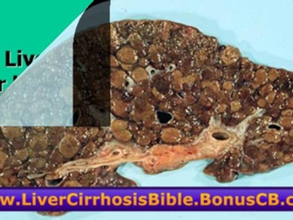 Liver Cirrhosis Levels - The Liver Cirrhosis Bible