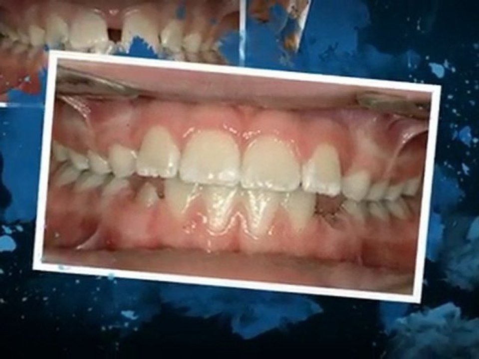 Orthodontist Braces Westminster