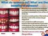 Dental veneers treatment  At affordable Cost