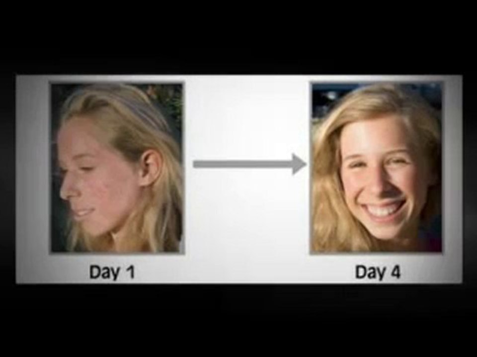 Acne Free In Just 3 Days!