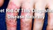 Eczema Cures Natural | Natural Eczema Cures | Eczema Cures