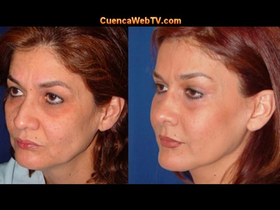 Ecuador plastic surgery - Dr Guerrero