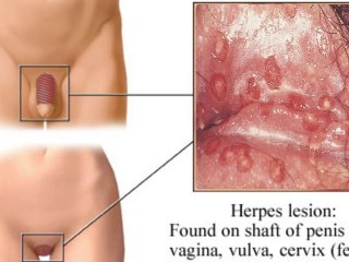Antiviral herpes treatment - HSV-Zero.com