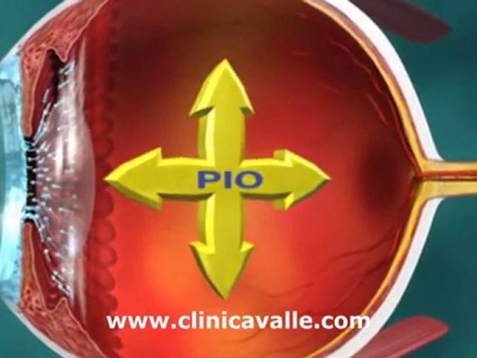 Glaucoma Primario de Angulo Abierto