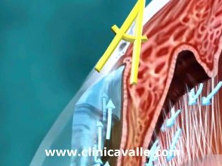 Glaucoma Primario de Angulo Cerrado