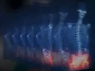 DePuy ASR Recall