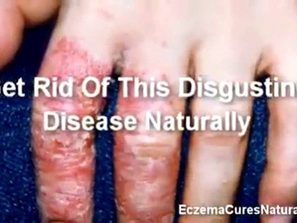 Learn The Eczema Treatment | Natural Eczema Cures | Eczema