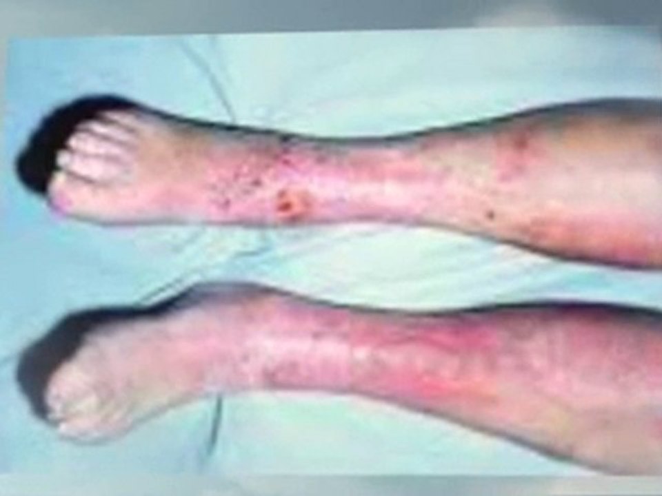 Eczema Rashes, Signs and Symptoms