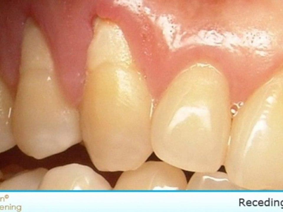 Teeth Whitening Strips and Kits - Sensitive Teeth