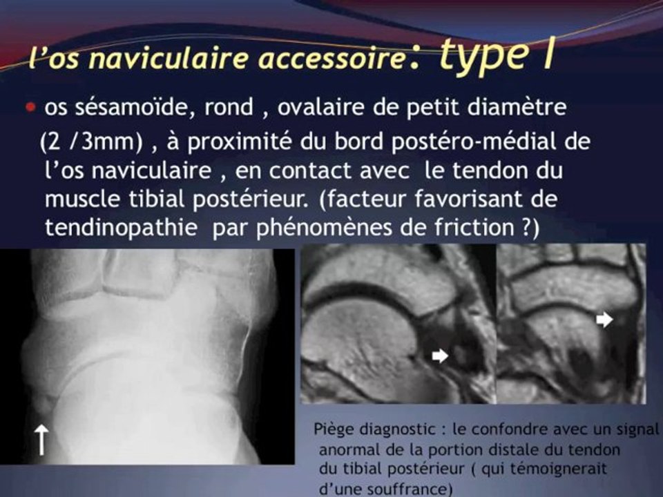L’os naviculaire et ses variantes - Vidéo Dailymotion