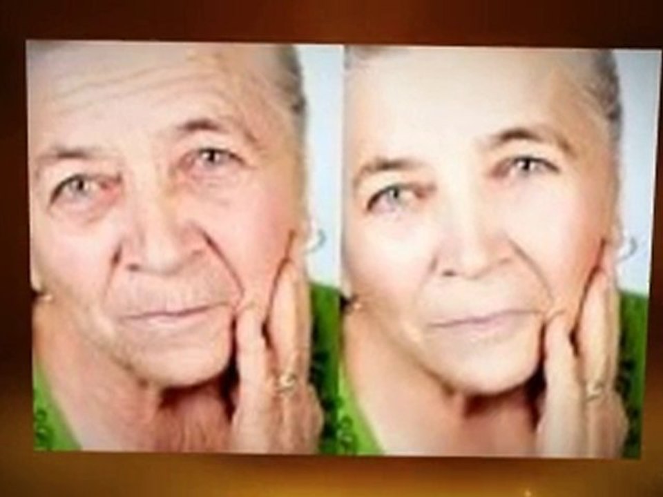 Botox Dysport - 3 Reasons Why You Should Botox/Dysport