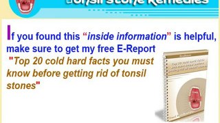How to Get Rid of Tonsil Stones Naturally?